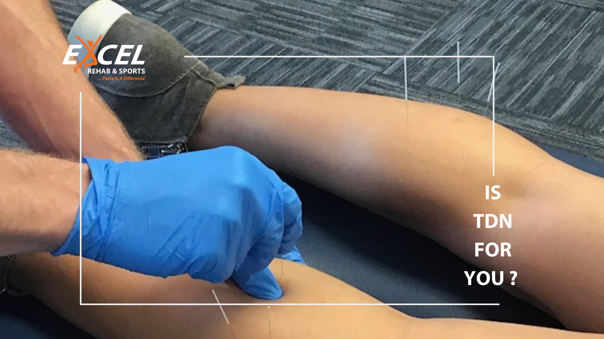 You are currently viewing Therapeutic Dry Needling