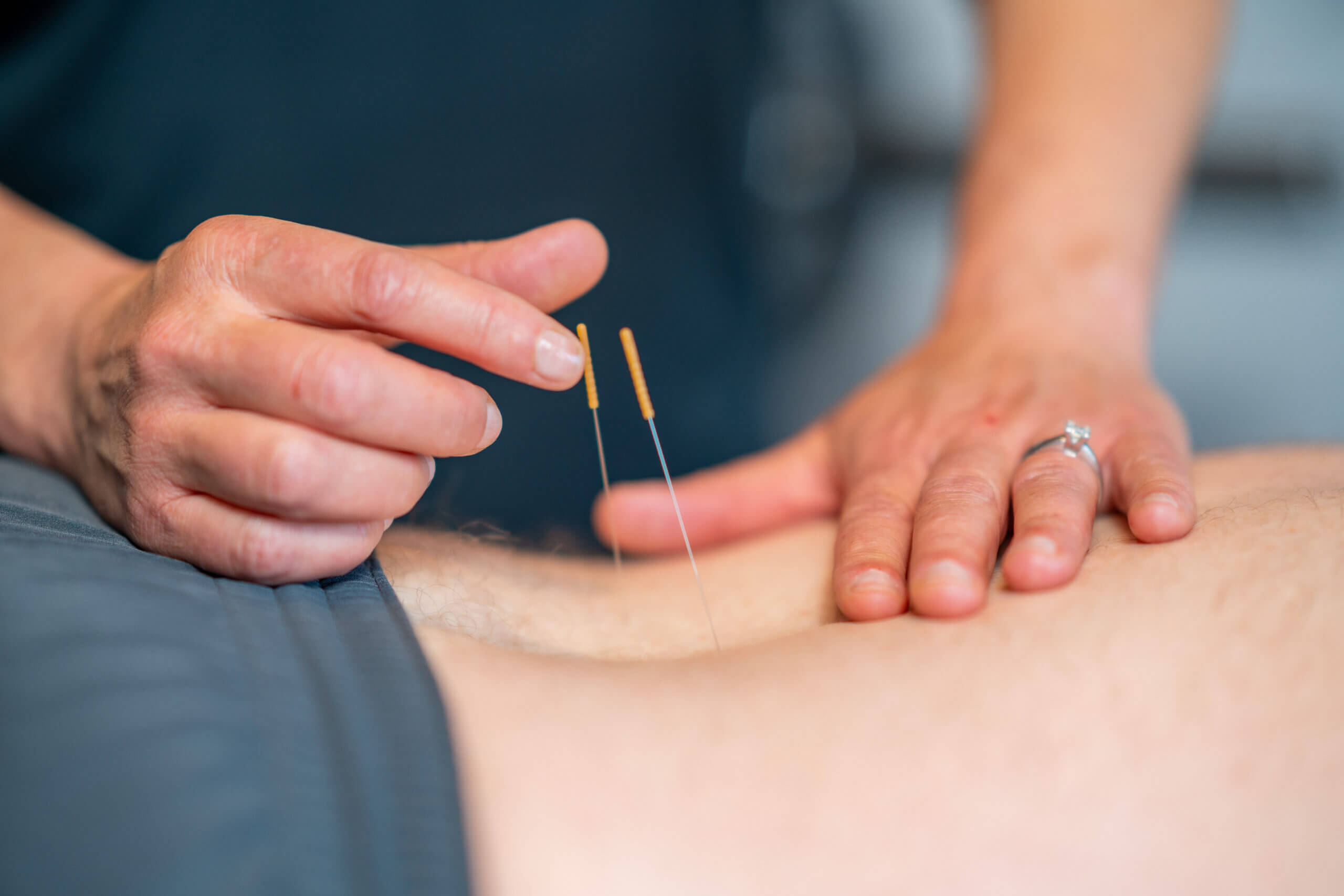 Dry Needling in Apache Junction, AZ